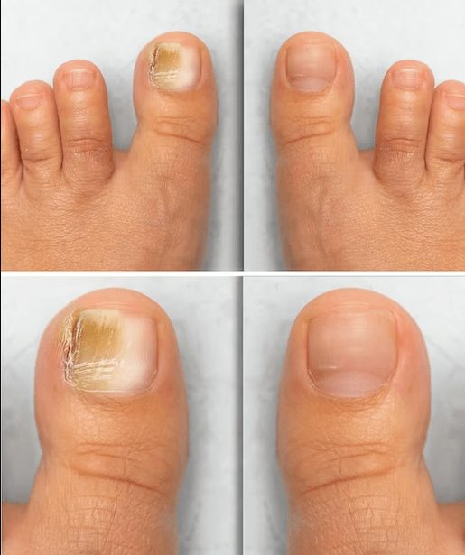Feet fungus - before and after the funeral cream treatment