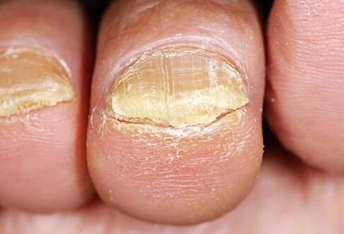 Symptoms of toenail fungus