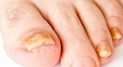 How to treat nail fungus