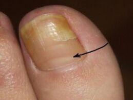 How to recognize the presence of a nail fungus at the thumb of the leg
