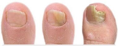 Stadiums of the development of mushrooms on the nails
