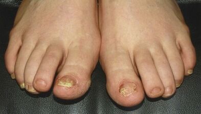 Signs and symptoms of mushrooms on the nails
