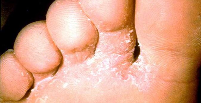 The lesion of the skin fungus between the toes