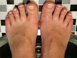 Mushroom on nails and skin of the legs