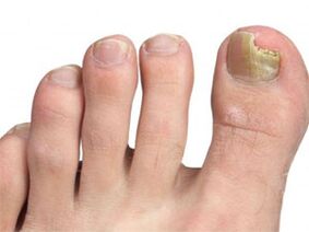 Yellow spots on the nails of the foot signal of the mushroom