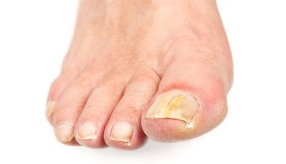 Yellowing of the nail due to a fungal infection