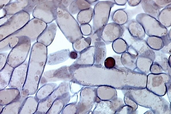 Nail fungus cells under the microscope