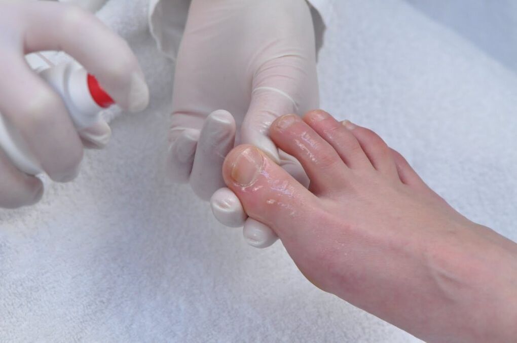 Treating fungal fingers with an antifungal drug