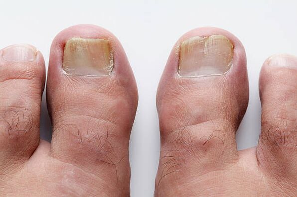 Type of toenail fungus