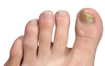 Fungus on big toenail