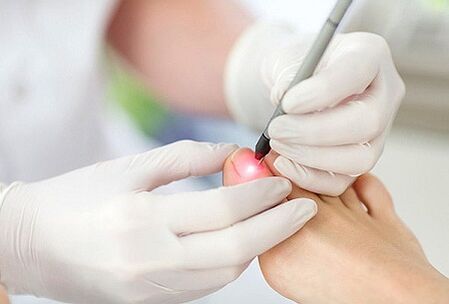 Laser treatment for toenail fungus