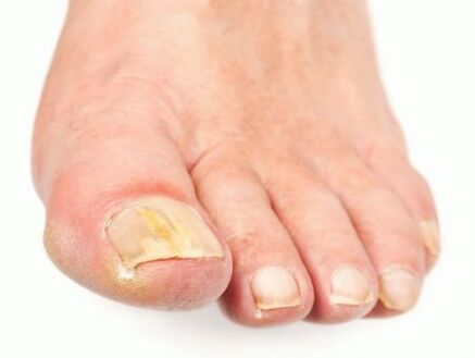 Nail fungal damage