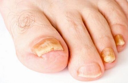 Yellowing of the toenails due to fungal infection