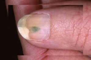 Fungal infection of the nail plate