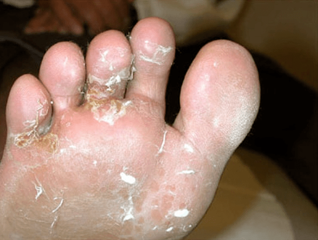 Development of fungi on the toes