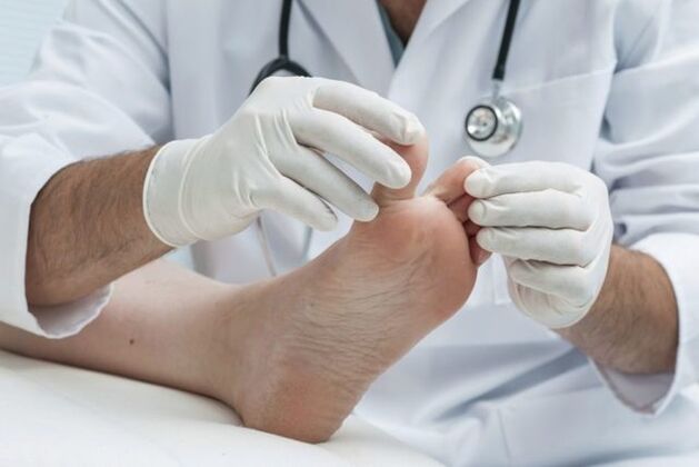 Diagnosis of athlete's foot by a doctor
