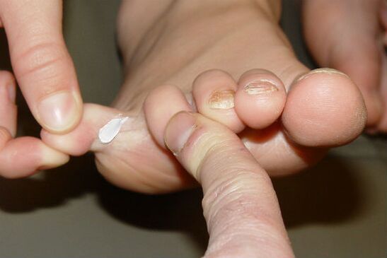 Fungus between toes