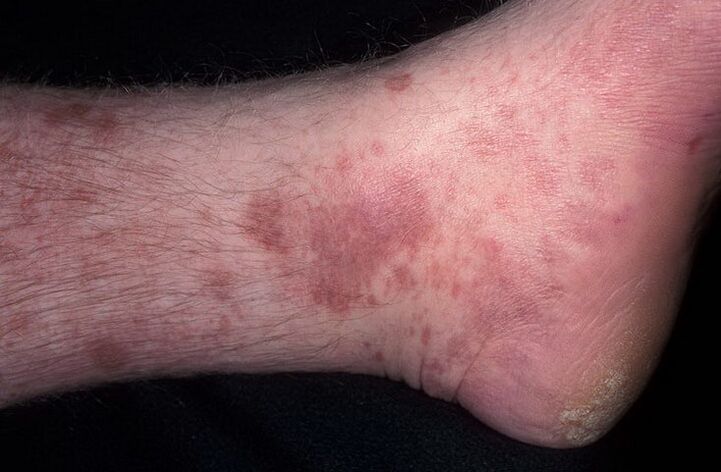 Mycotic eczema on the leg