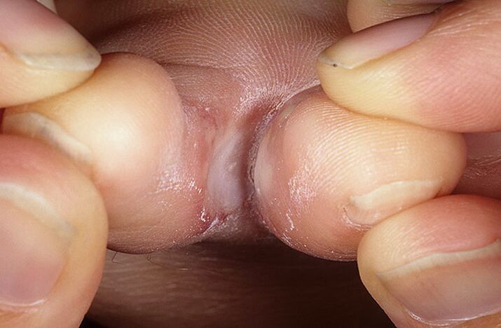 Squamous hyperkeratotic form of the fungus