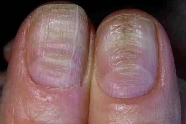 Fungal infection of the nail plate