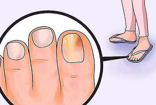 Fungus on toenails