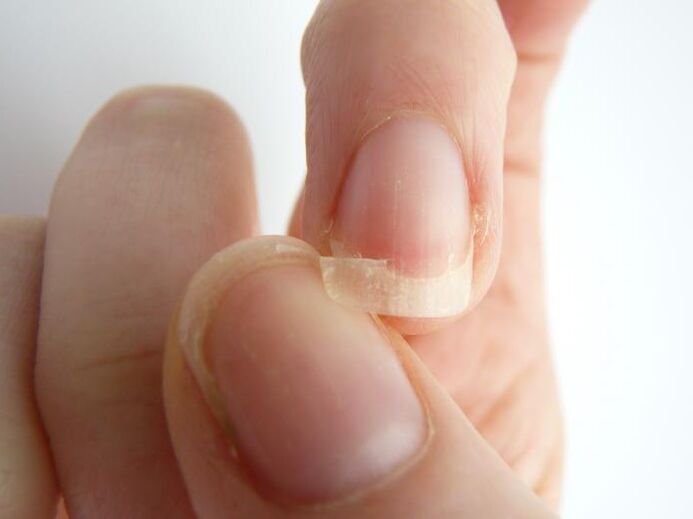 Nail detachment due to fungus