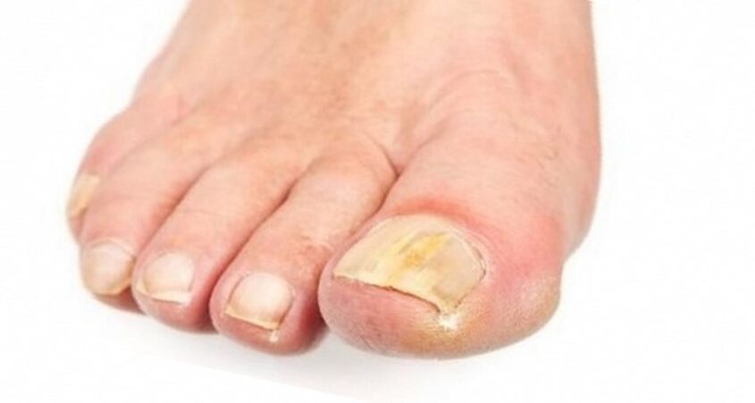 Yellowing of the nail due to fungus