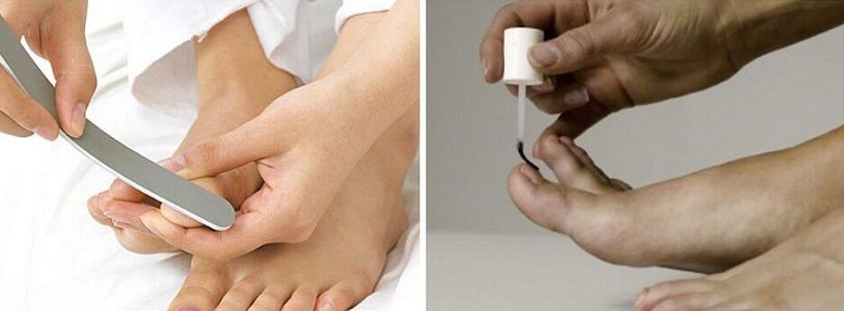 Treatment of nail fungus with varnish
