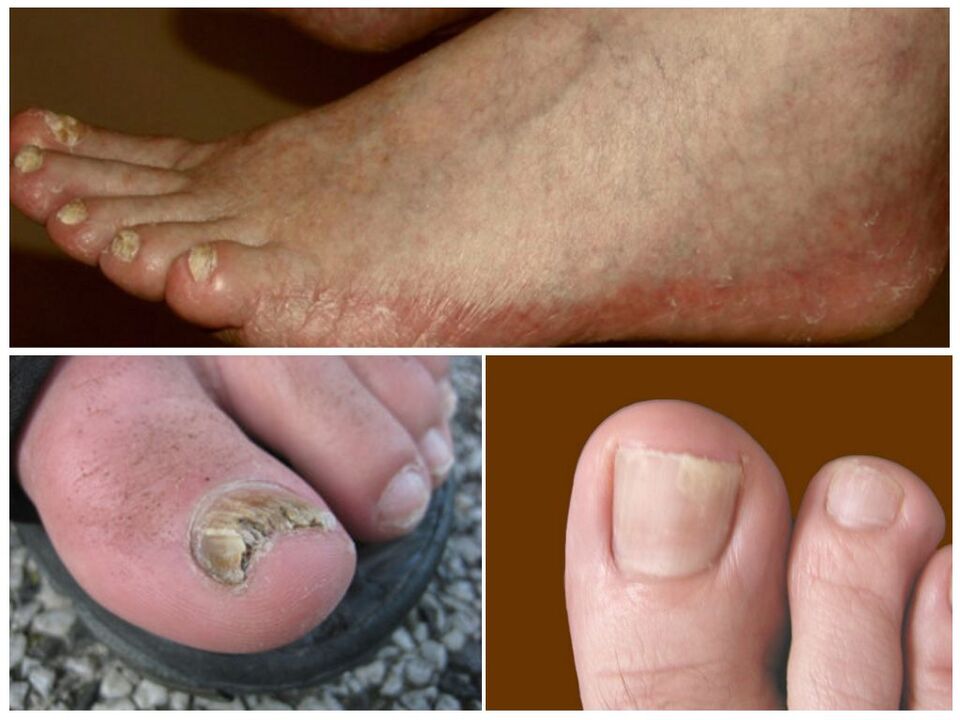 Types of athlete's foot